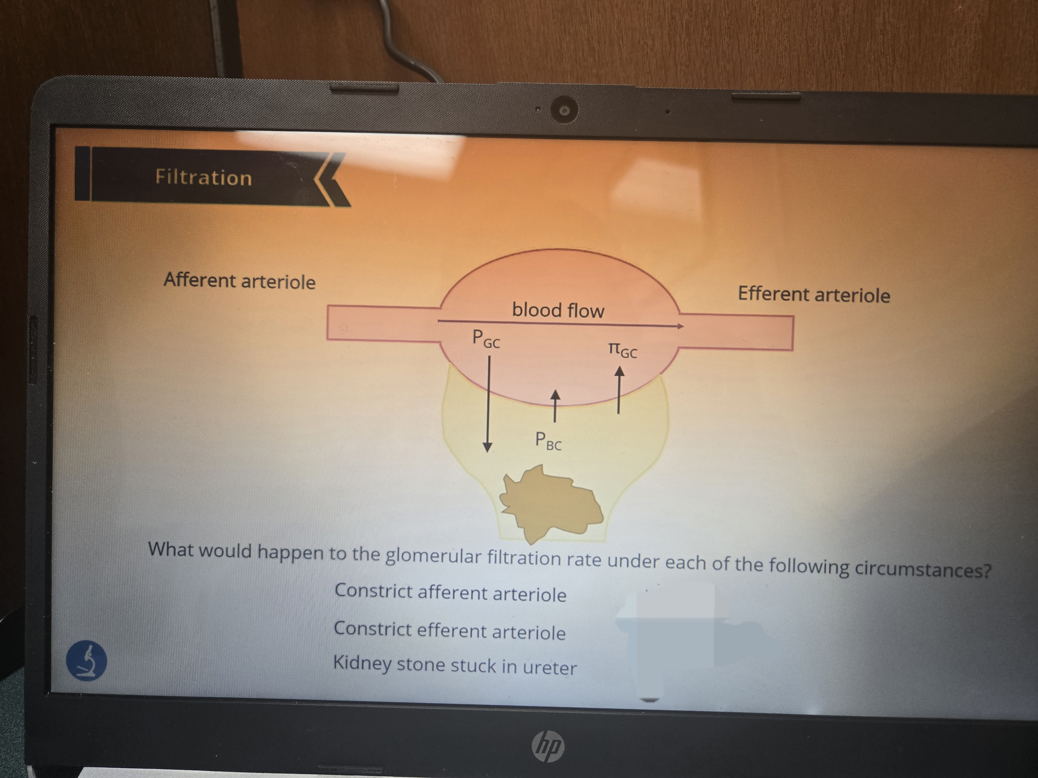 <p>What if there was a kidney stone?</p>