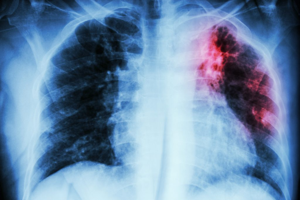 <p>Two stages:</p><ol><li><p><strong><u>Latent tuberculosis:</u></strong></p></li></ol><ul><li><p>TB bacteria invade alveoli, multiply &amp; form tubercles (lumps) where they remain alive, but dormant</p></li><li><p>The immune system surrounds them with fibrous scar tissue</p></li></ul><ol start="2"><li><p><strong><u>Active tuberculosis:</u></strong></p></li></ol><ul><li><p>After months or years, bacteria become active, multiply in lung cells &amp; destroy them</p></li><li><p>The bacteria can spread via the bloodstream to other organs, where they invade &amp; damage tissues</p></li></ul><p></p>