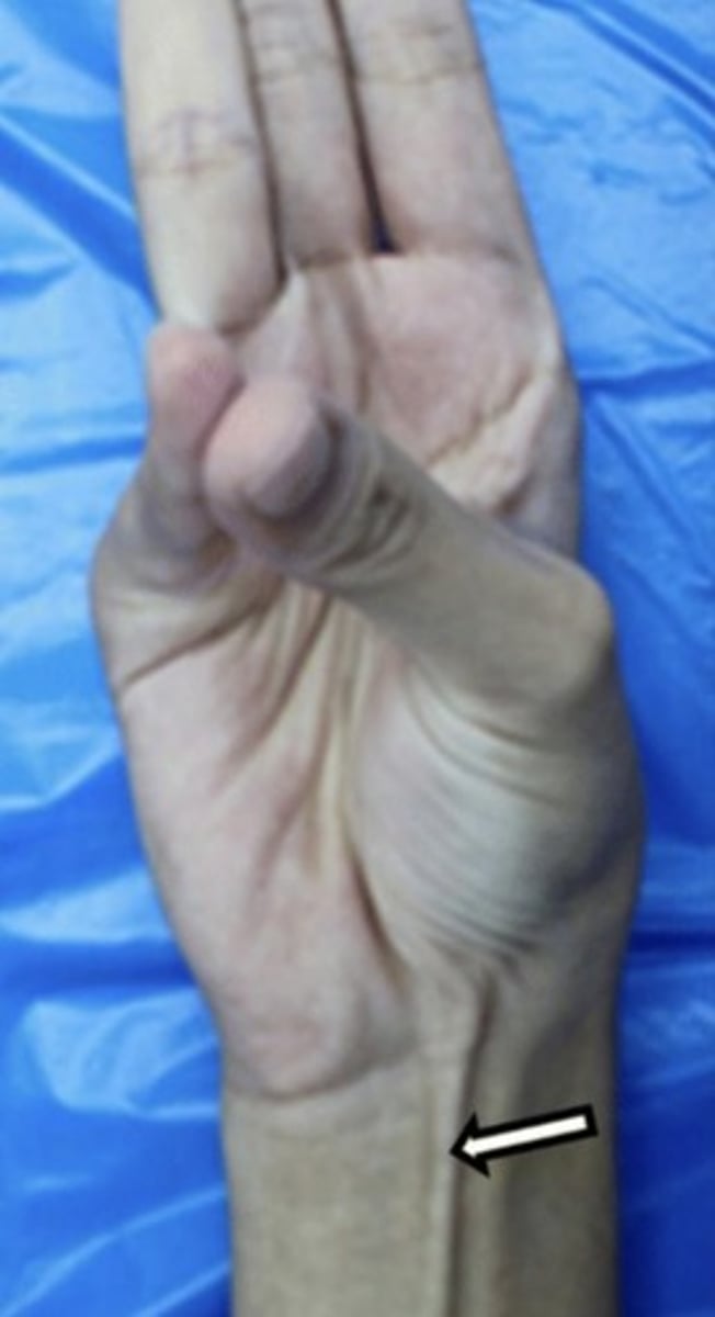 <p>What are the (2) attachments of the Palmaris Longus?</p>