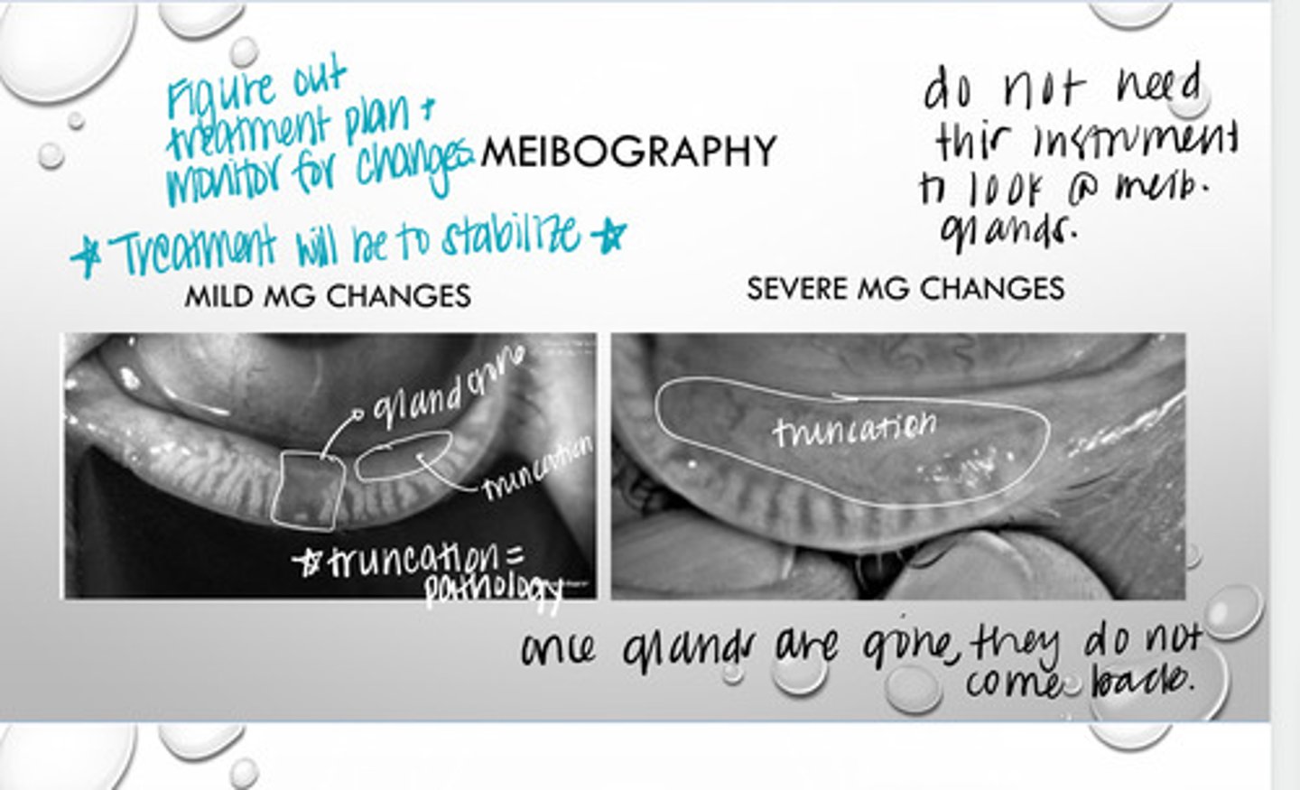 <p>shortening or loss of length of the meibomian glands observed on meibography</p>