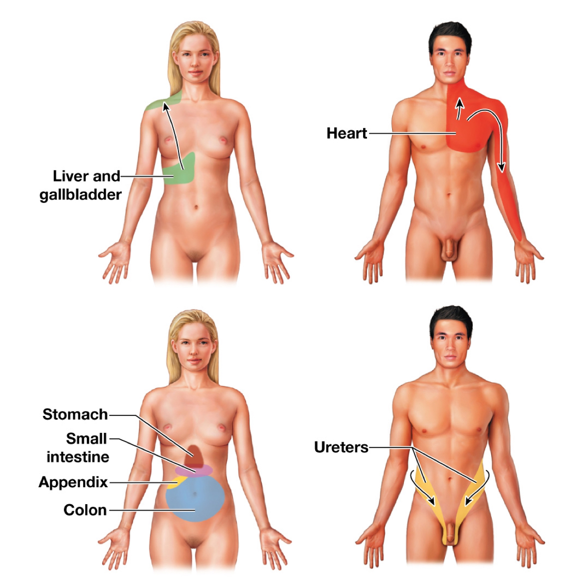 <p><strong>Visceral </strong>pain can manifest as <strong>body surface </strong>pain</p><p>Ex/ Heart attack frequently felt as pain in the left arm</p>