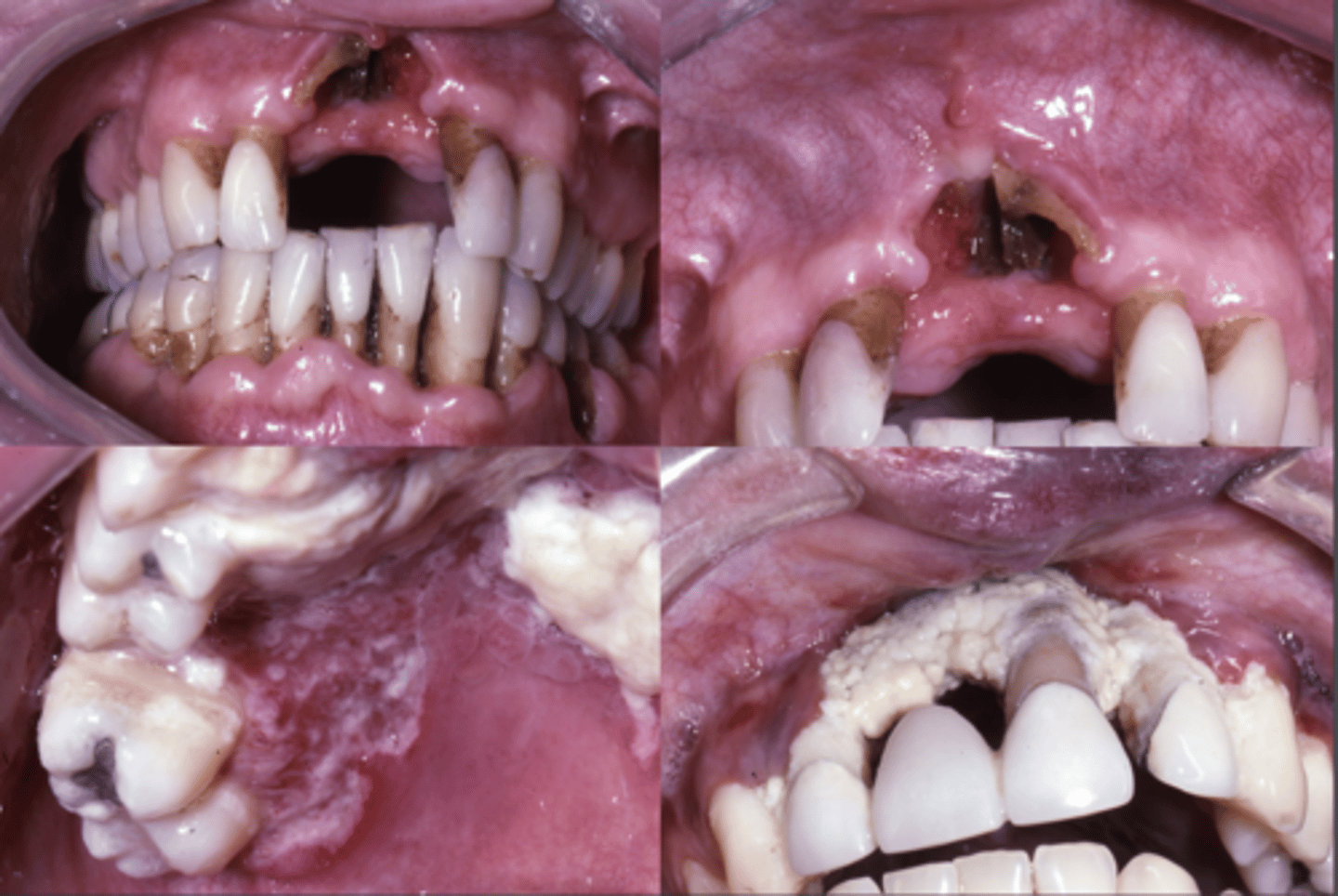 <p>destruction of periodontal tissues</p><p>• associated with HIV</p>