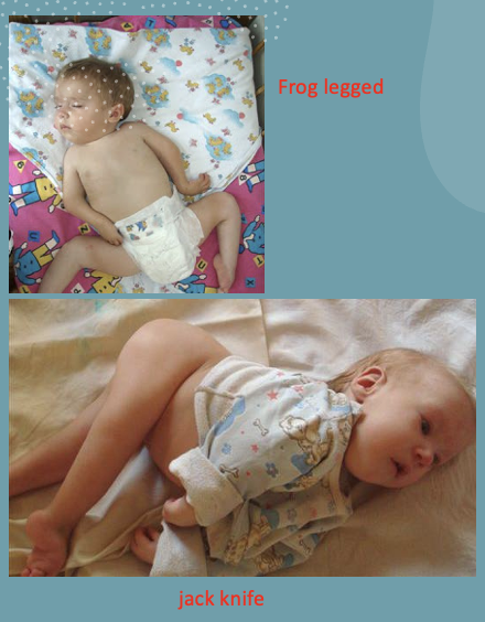 <ul><li><p>frog legged </p></li><li><p>jack knifed </p></li></ul><p></p>