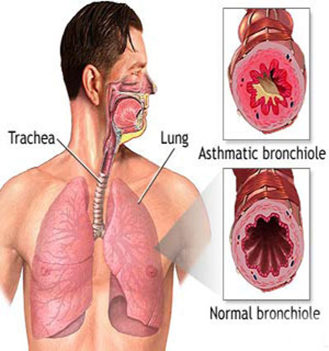 <p>A high-pitched, whistling breath sound that is most prominent on expiration, and which suggests an obstruction or narrowing of the lower airways; occurs in asthma and bronchiolitis.</p>