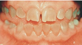 <ul><li><p>a type of dentin dysplasia</p></li><li><p>a hereditary basis</p></li><li><p>blue-gray or brown teeth with opalescent sheen </p></li></ul><p></p>