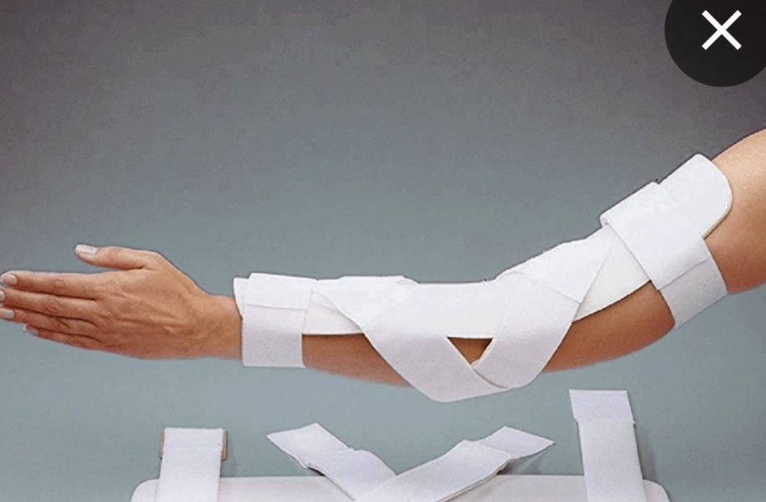 <ul><li><p>requires positioning in extension to prevent contractures, often using a splint for support. </p></li></ul><p></p>