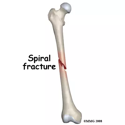 <p>Ragged break occurs when excessive twisting forces are applied to a bone (common sports fracture)</p>