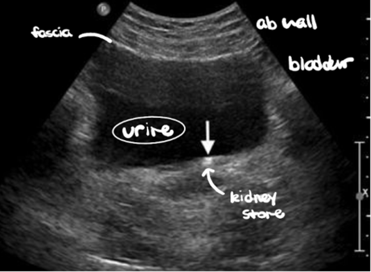 <p>Hyper-echoic abdominal wall vs. anechoic urine</p>
