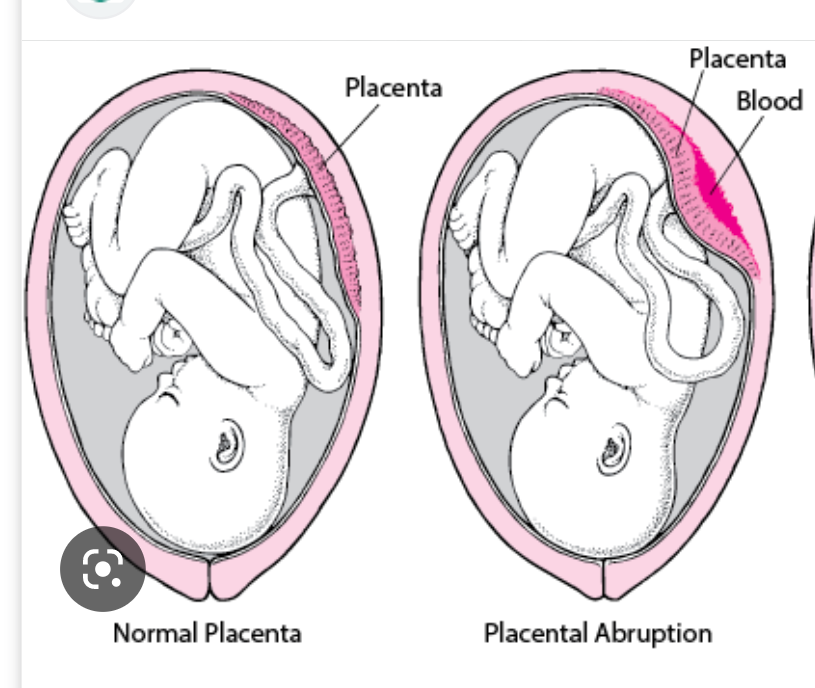 <p>• Premature separation of a normally implanted placenta from the uterine wall</p><p>• Accounts for significant maternal &amp; fetal morbidity and mortality</p><p></p><p>• Risk factors : -trauma, smoking, cocain use, multiple pregnancy,  too much amnionitic fluid, diabeteies</p>