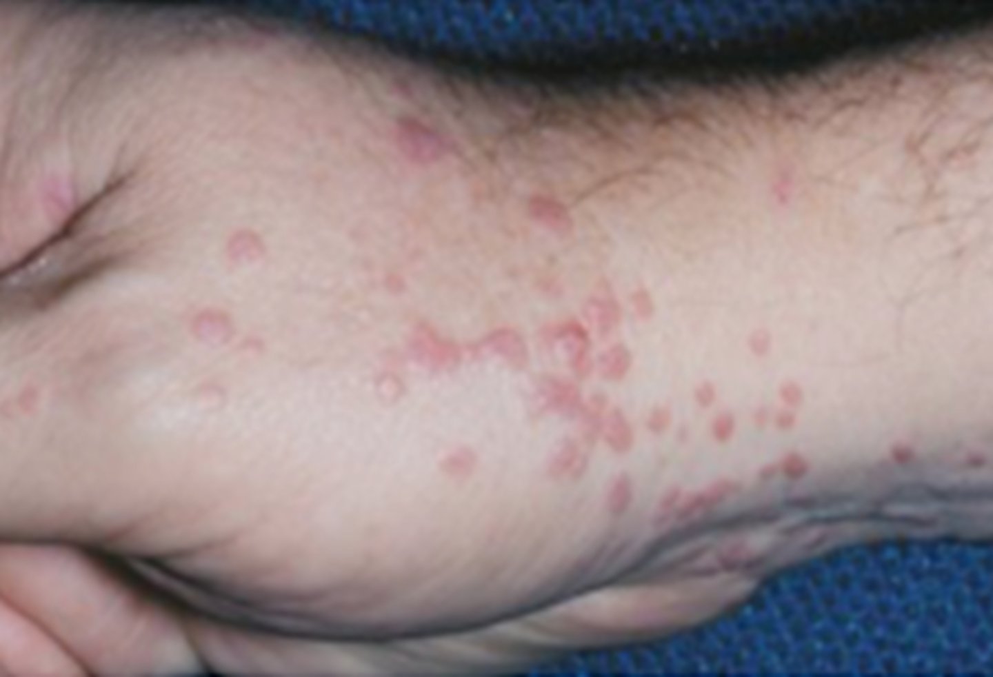 <p>Hint: purple, pruritic, polygonal papules</p>