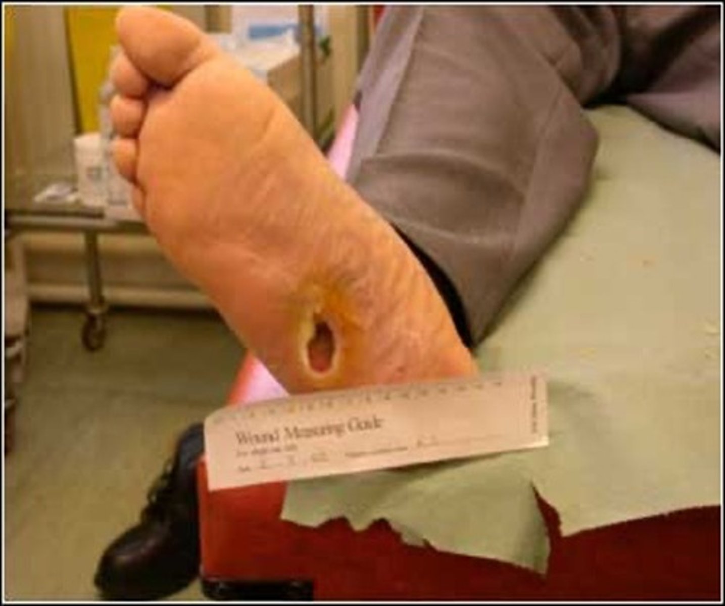 <p>Injury or predisposed by underlying neuropathy or ischemia</p>
