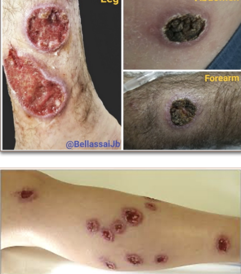 <p>§ Weeks/months after sandfly bite</p><p>§ Skin/mucosal papules that progress to nodule or ulcer</p><p>§ Raised, well-demarcated border “Volcano”</p><p>§ Painless OR painful</p><p>§ Can be destructive</p><p>§ Leaves a scar</p>