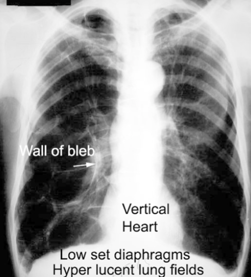 <p>difficult to see, may appear as absence of pulmonary markings</p>