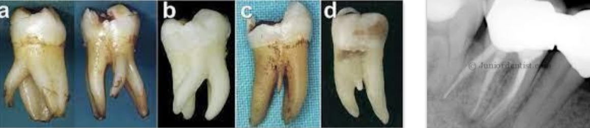 <p>3 roots</p><p class="has-focus">3rd root called <strong>Radix entomolaris</strong></p>