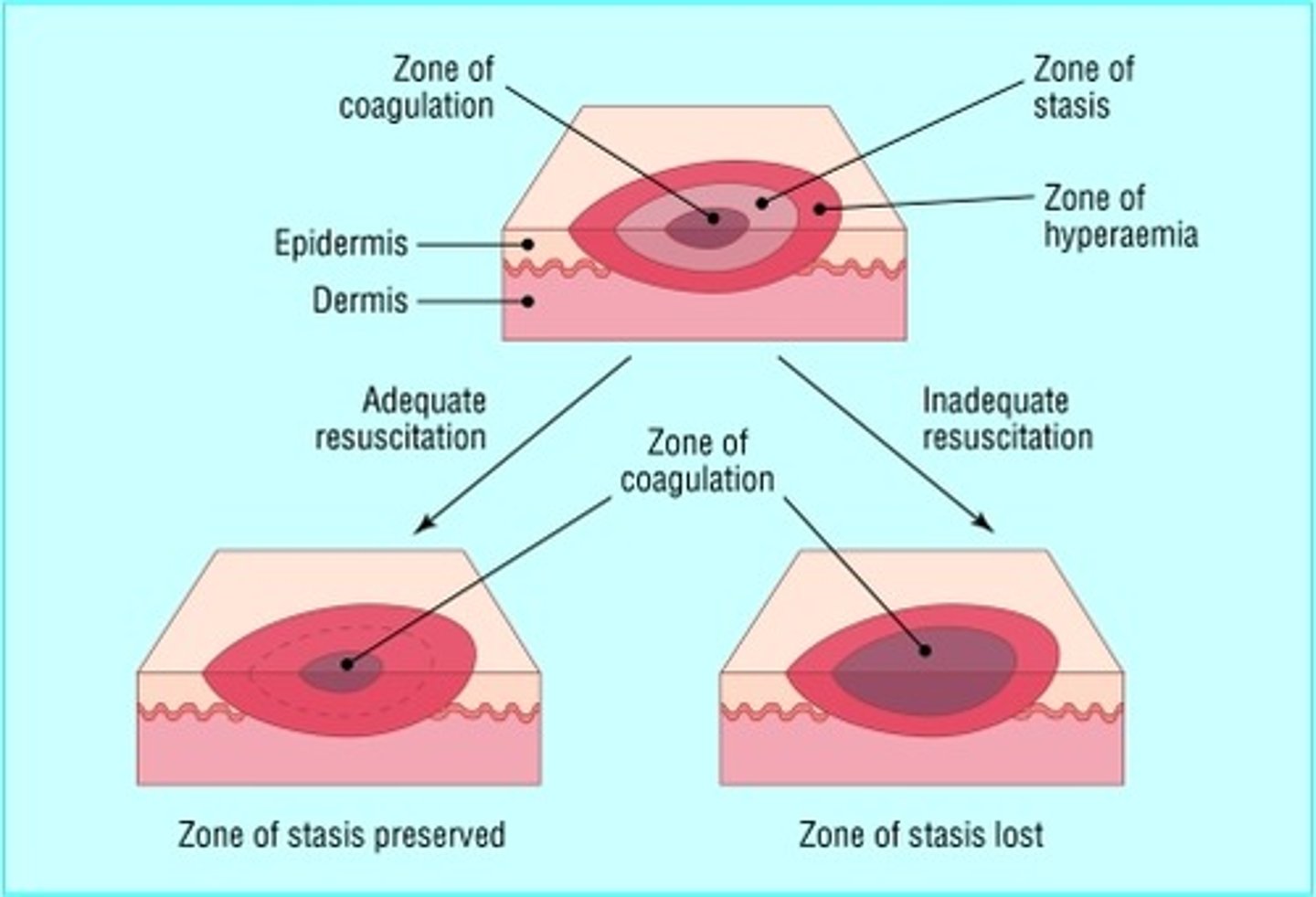 <p>Zone of coagulation—This occurs at the point of maximum damage. In this zone there is irreversible tissue loss due to coagulation of the constituent proteins.</p><p>Zone of stasis— decreased tissue perfusion, potentially salvageable tissue. </p><p>Zone of hyperaemia— outermost zone. tissue perfusion is increased. The tissue here will invariably recover unless there is severe sepsis or prolonged hypoperfusion.</p>