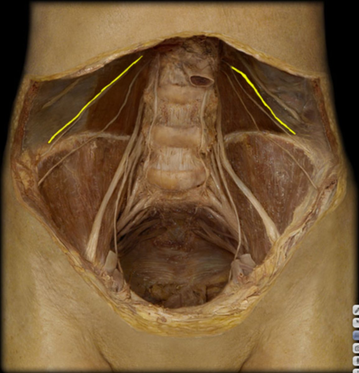 <p>arises from L1, gives motor functino to the naterolateral abdominal wall msucles and innervates sensory fro skin in the pubic region. Injury to the anterior branch can occur during appendectomy causing decreased sensation at the suprapubic region.</p>