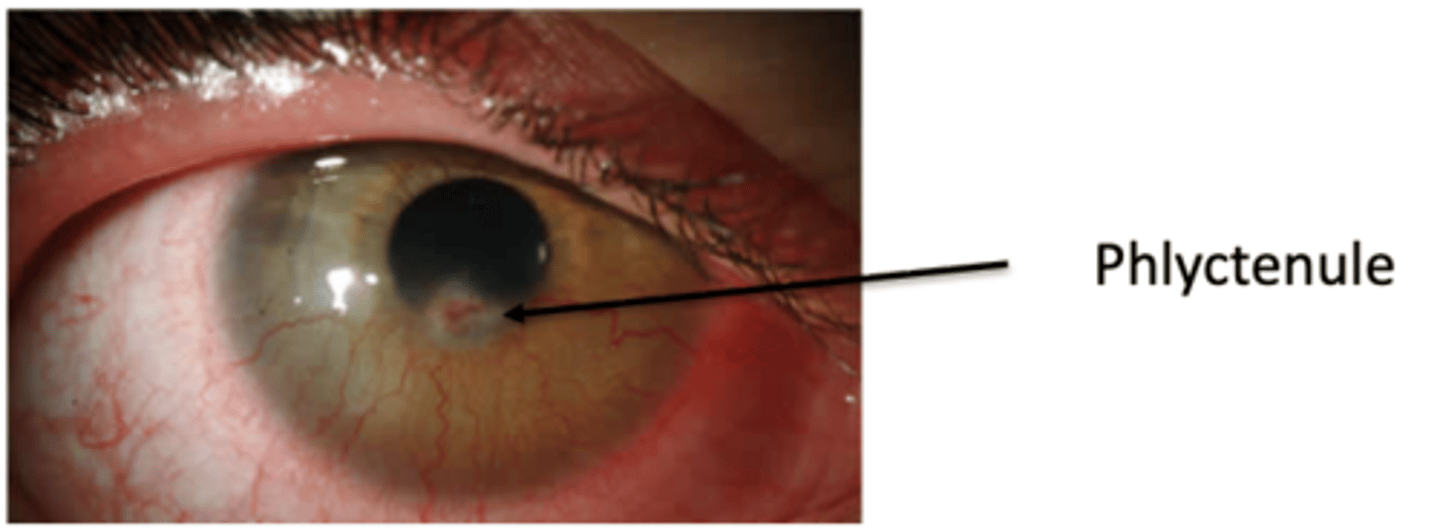 <p>How would phlyctenulosis present?</p>