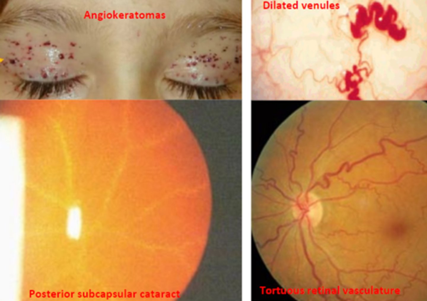 <p>an X linked recessive disorder that results in irreversible, potentially life threatening diseases of the kidney, heart, and brain. Is caused by a deficiency of alpha galactosidase A that results in dysfunction of lysosomal storage. Corneal changes, including vortex keratopathy, are the earliest and most consistent ocular abnormality. Symptoms generally appear in childhood, but go undiagnosed until adulthood.</p>