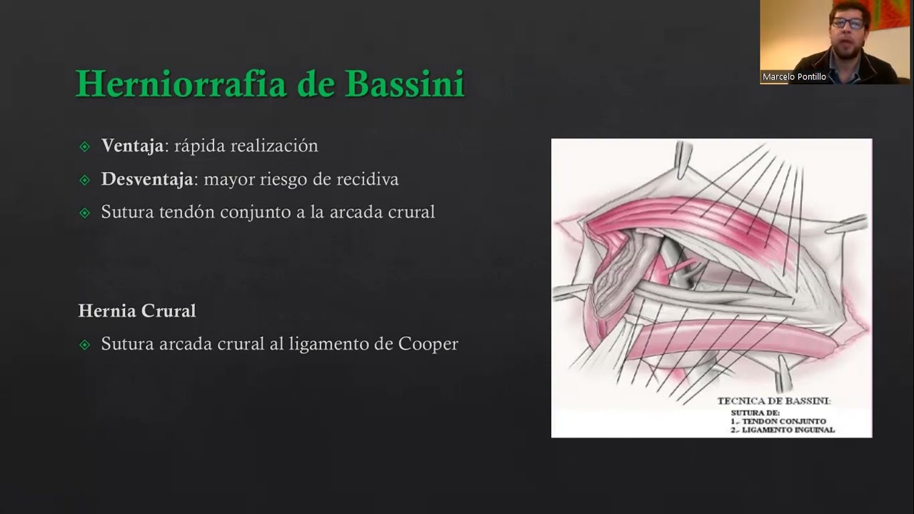 <p>sutura tendão conjunto no ligamento inguinal, passando pelo oblíquo interno e transverso do abdome e evitando oblíquo externo</p><p>hérnia inguinal</p><p>técnica com tensão e mais risco de recidiva</p>