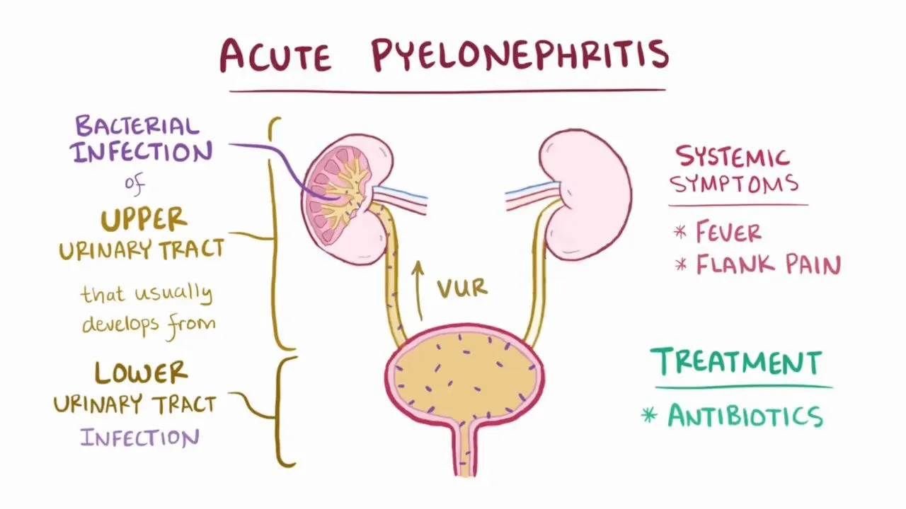 <p><span style="color: blue"><strong>Kidney </strong></span><strong>inflammation / infection </strong>caused by <span style="color: blue"><strong>UTI</strong></span></p><ul><li><p><u>Acute </u><strong>= non-permanent</strong> damage</p></li><li><p><u>Chronic </u>= <strong>permanent</strong> damage, possible <strong>renal failure</strong></p></li></ul><p></p>