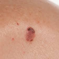 <p>a common form of skin cancer that develops in the squamous cells that make up the middle and outer layers of the skin. Squamous cell carcinoma of the skin is usually not life-threatening, though it can be aggressive.</p>