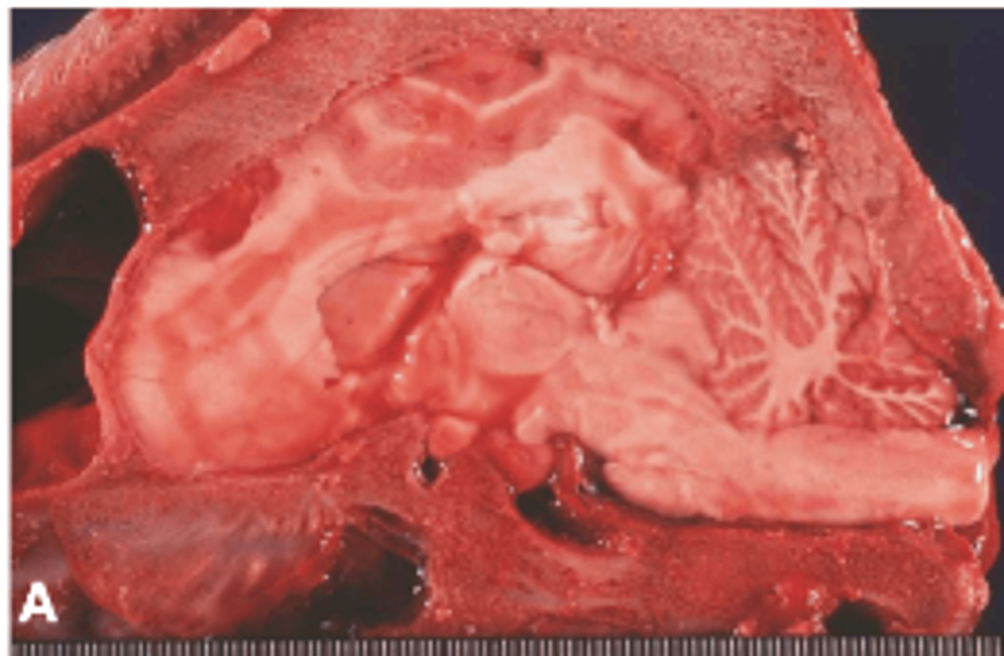 <p>- Cerebellum through the foramen magnum ("coning" of the cerebellum)</p><p>- Cerebrum through the tentorium cerebelli (Transtentorial herniation)</p><p>- Cerebrum across the falx cerebri (midline septum)</p>
