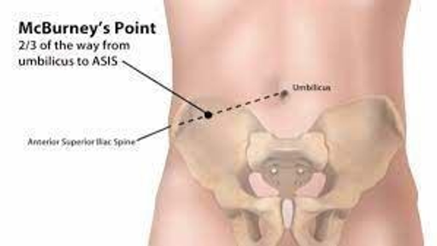 <p>The location in the right lower quadrant where pain from appendicitis is typically felt.</p>