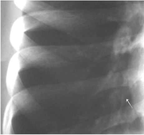 <p>usually not indicated in acute exacerbations. Long-standing may show interstitial patterns due to scarring or mild bronchiectasis</p>