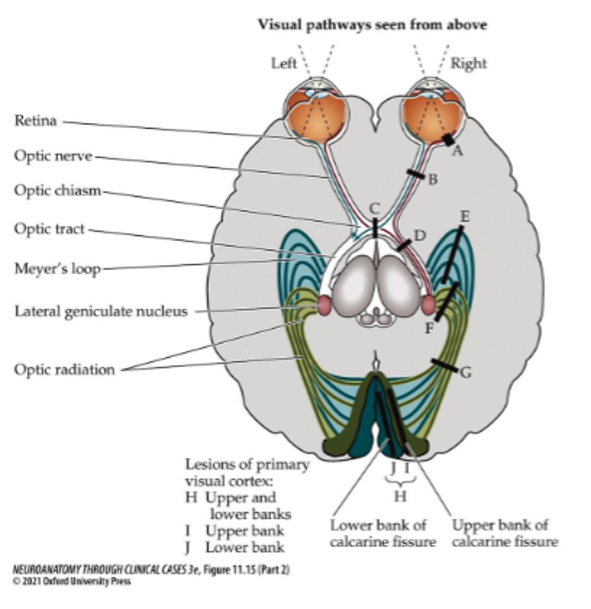 <p>Right superior portion of optic radiation</p>