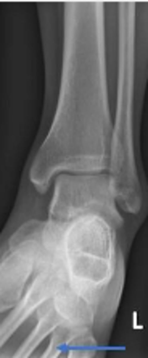 <p>What bone are the arrows pointing t</p>