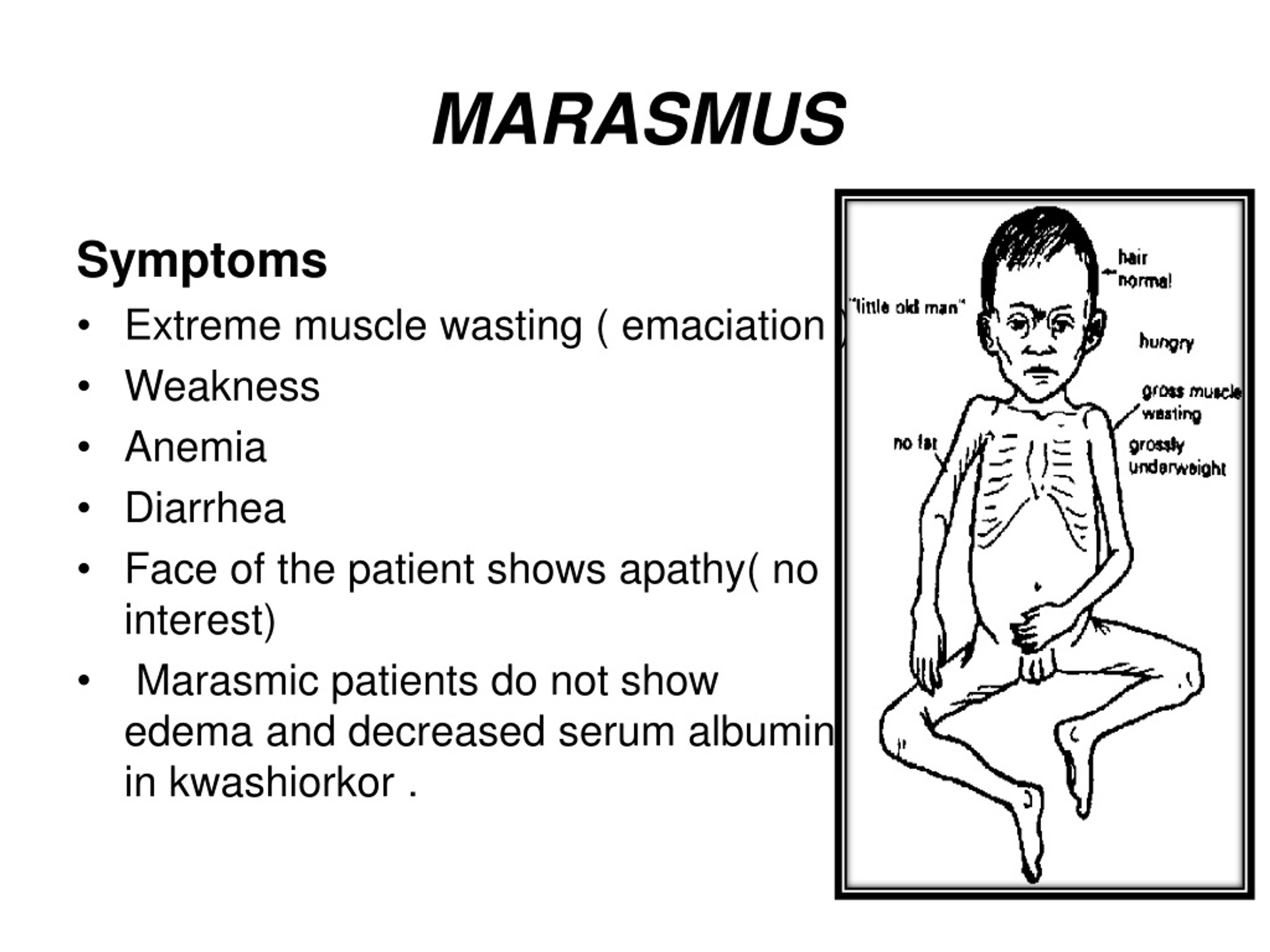 <p>Marasmus</p>