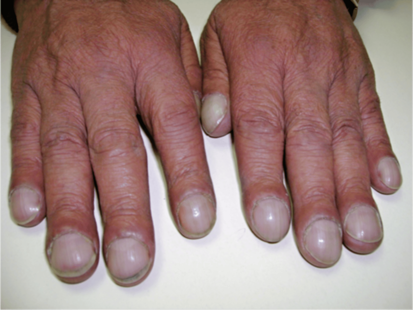 <p>-hypertrophic osteoarthropathy</p><p>-enlargement and swelling of the nail beds</p><p>-usually due to chronic respiratory problems of cyanotic heart conditions</p>
