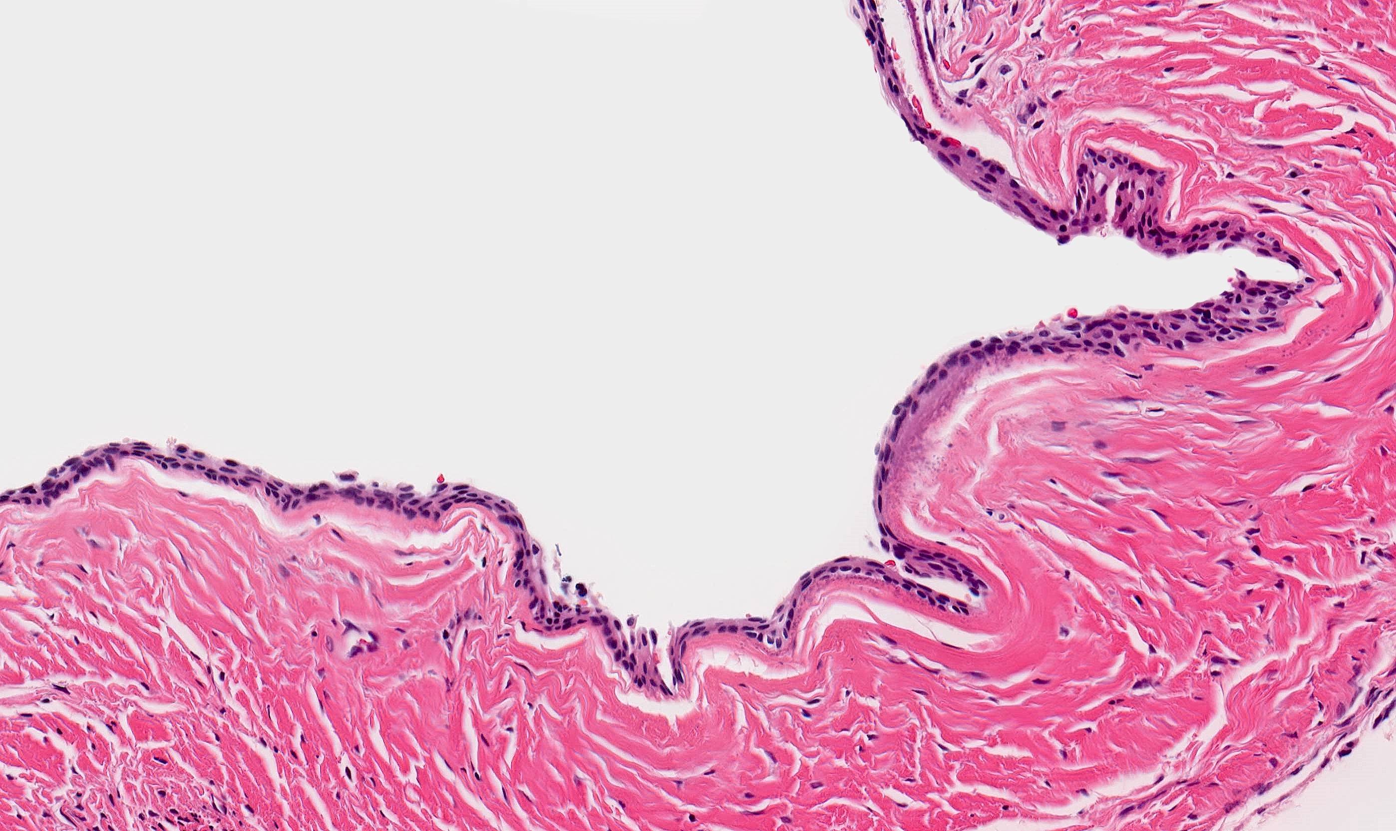 <p>1) kyste dentigère</p><p>2) Kyste autour d’une dent non éruptée </p><p>3) </p><ul><li><p>Epithélium pluristratifié non kératinisant </p></li><li><p>Corps de Rushton</p></li><li><p>Rares reste odontogènes </p></li></ul><p></p>