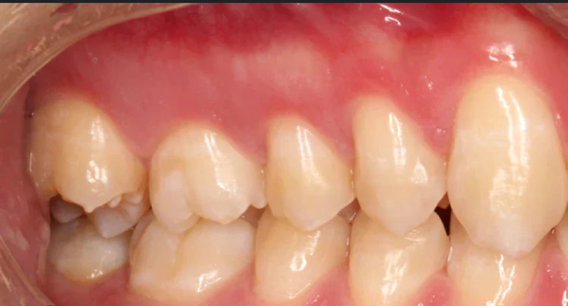 <p>The teeth at the back of the mouth (pre molars &amp; molars)</p>
