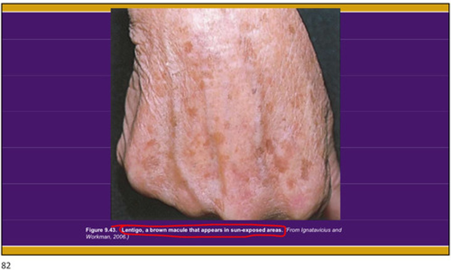 <p>Lentigo</p><p>-just a sign of sun damage in the past, no cancerous</p>