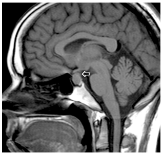<p><span><em>A 25 yo woman became ‘sluggish’ and easily fell asleep. She had gained 17 pounds in the last three months, and on exam her face looked ‘like a mask’ – her jaw was large and her eyebrow ridges prominent.</em></span></p><p><span><em>She had trouble seeing to the left in the left eye, and to the right in her right eye</em></span></p>