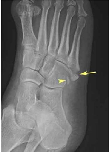 <p>Avulsion fracture</p>