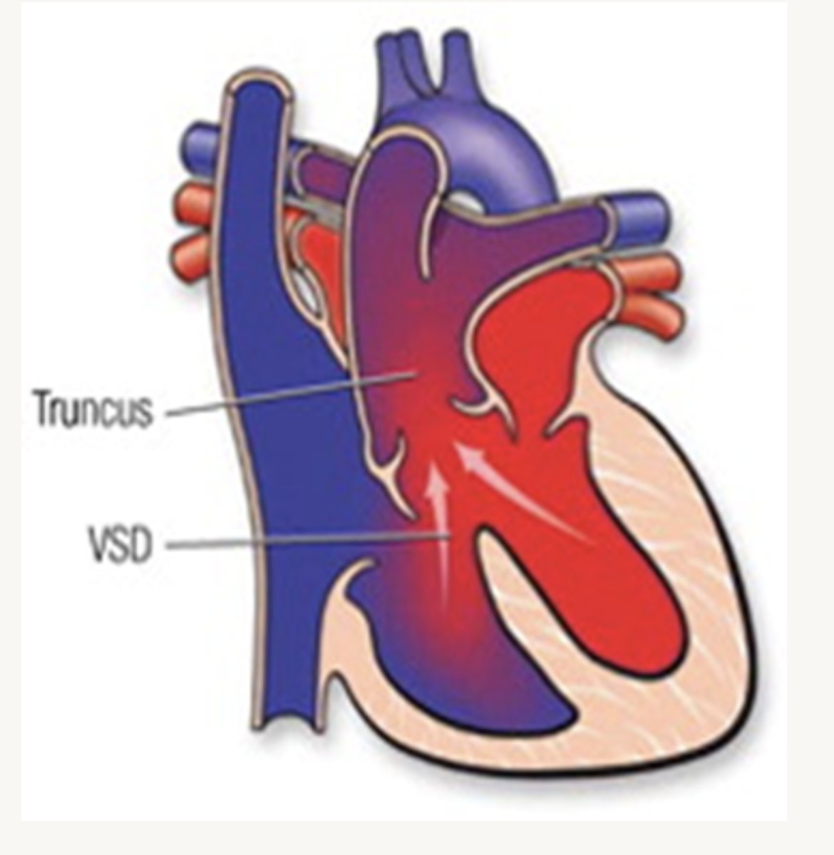 <p>pulmonary blood flow is increased and systemic blood flow reduced</p>