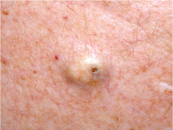 <p>what condition?</p><ul><li><p>skin colored benign dermal nodule often w/ visible central punctum</p></li><li><p>cyst wall made of normal stratified squamous epithelium</p></li><li><p>nontender, freely moveable </p></li><li><p>filled w/ thick malodorous keratin material</p></li></ul><p></p>