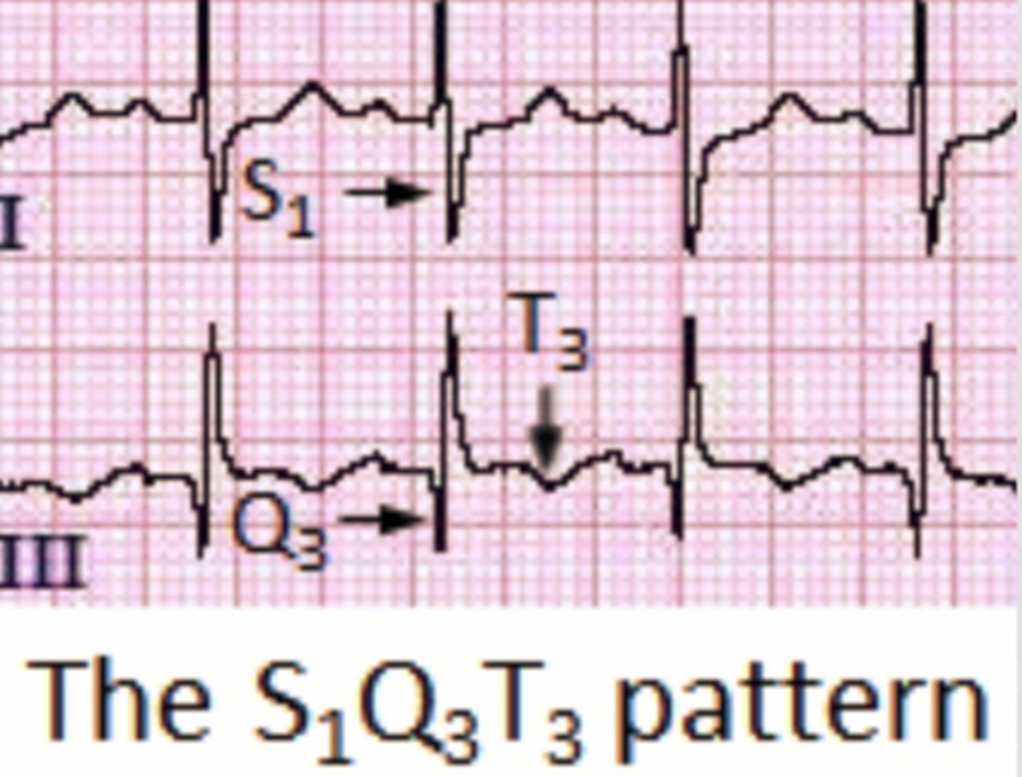 <p>S1Q3T3</p>
