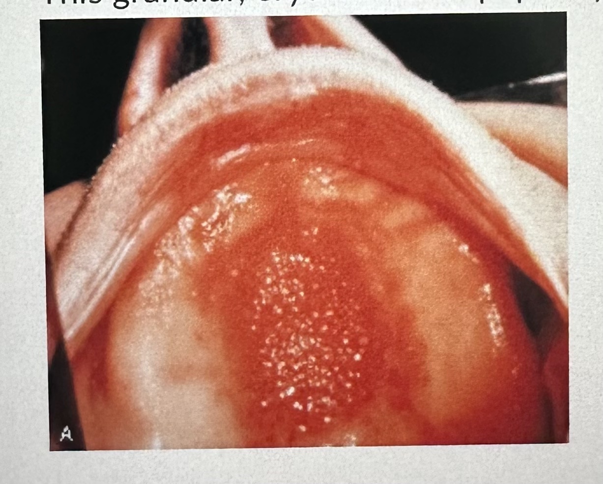 <p><span>This granular, erythematous papillary surface of the palatal vault was caused by:</span><br><br><span>A. poor oral hygiene</span><br><span>B. an ill-fitting suction area of a maxillary denture</span><br><span>C. the denture flange</span><br><span>D. soaking the denture in caustic rinses</span></p>