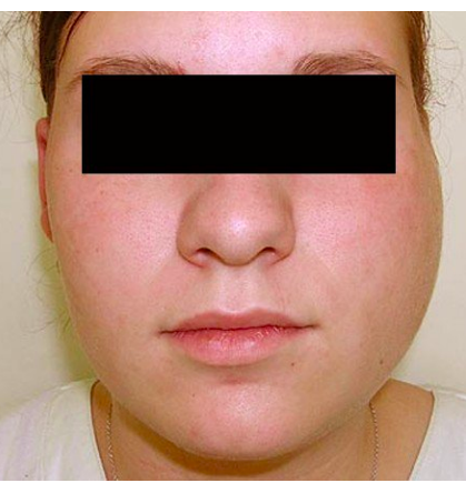 parotitis 

* swelling anterior to earlobe
* swelling above angle of jaw
* usually unilateral