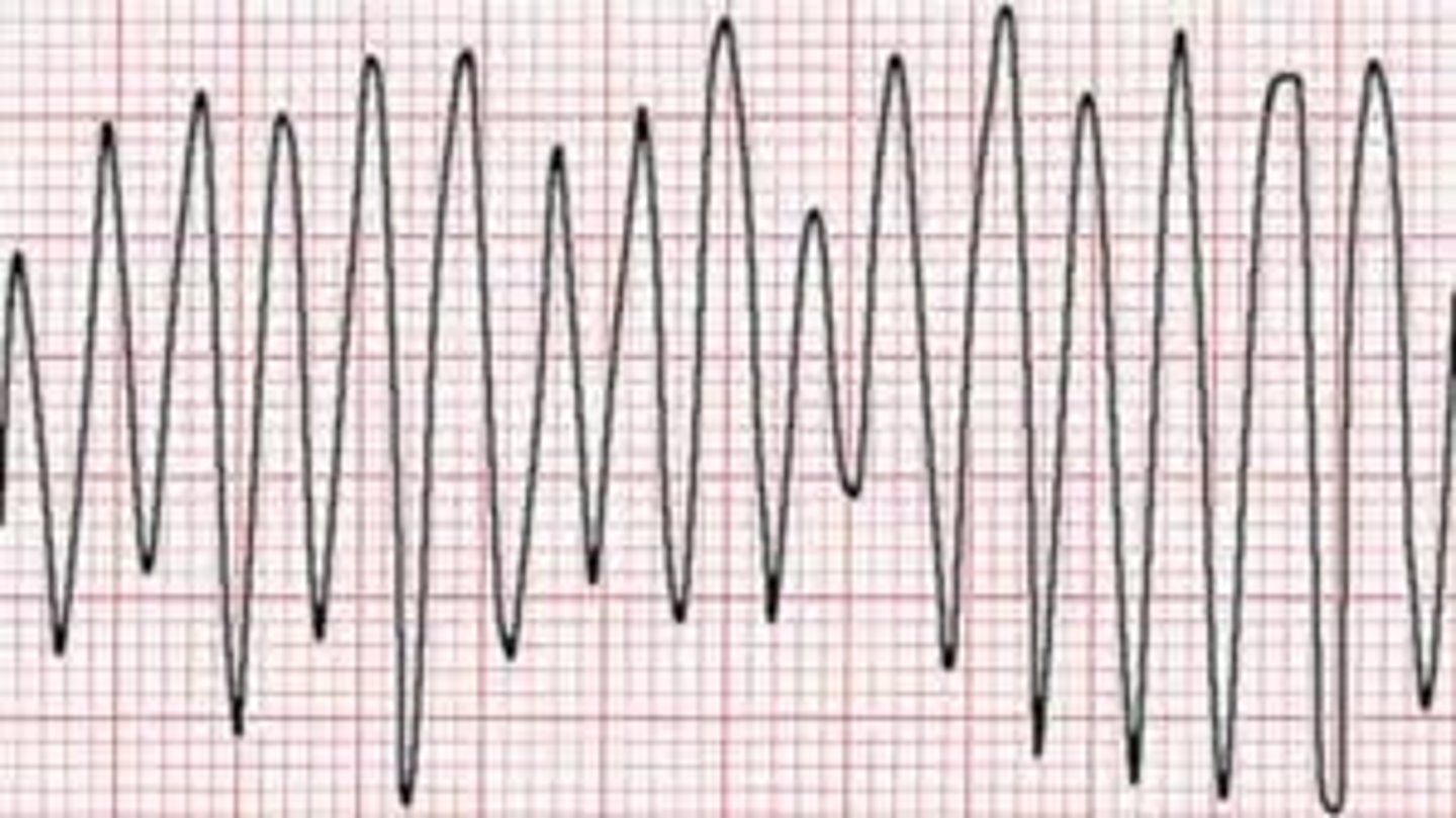 <p>250-350</p><p>- smooth sine-waves w/ similar amp</p><p>- can lead to deadly arryth</p><p>goes right into vfib</p>
