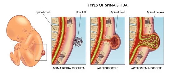 <p>spina bifida</p><p></p>