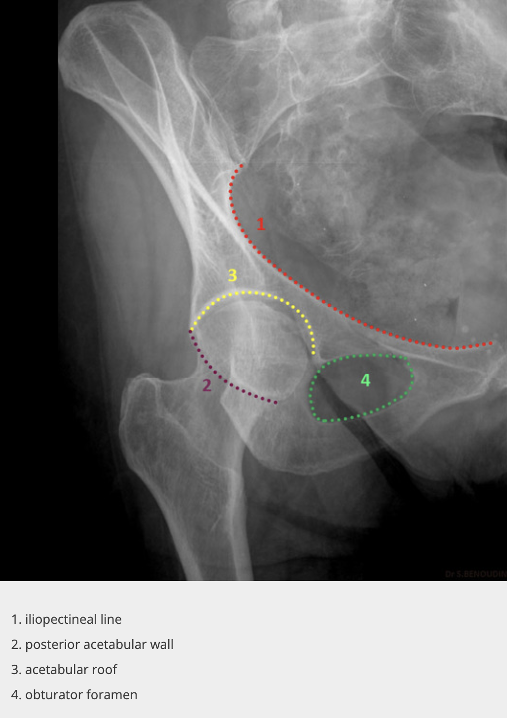 <p>affected</p><p>obturator ring, posterior wall</p>