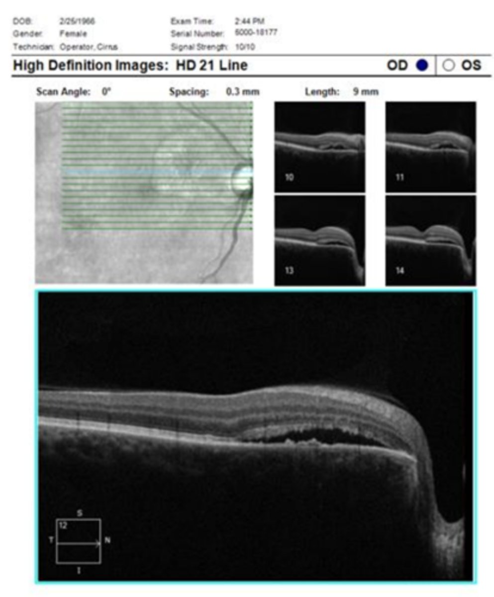 <p>more at outer macula, not directly involving fovea</p>