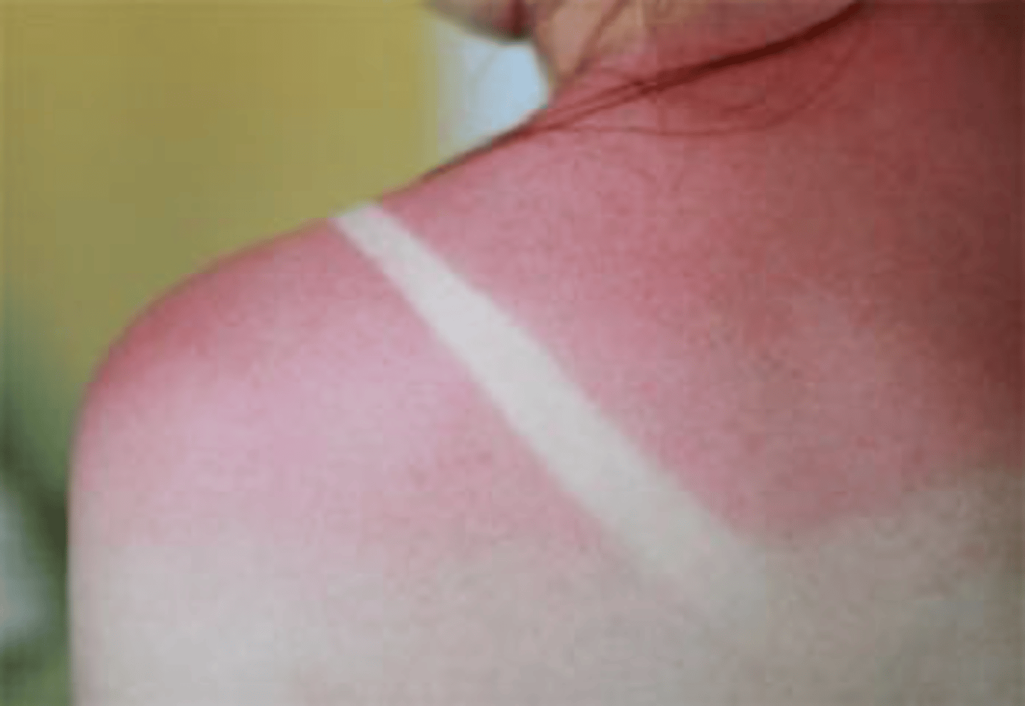 <p>1. mostly sun burns or steam injuries</p><p>2. blanchable (adequate blood flow to site)</p><p>3. medical management most often NOT needed</p><p>4. NO ice to the site</p><p>5. pretty painful</p>