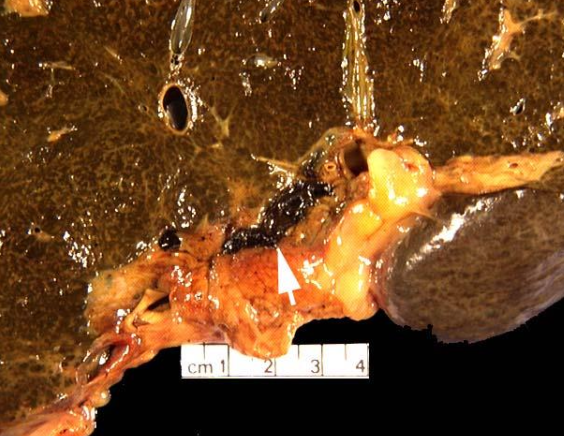 <p>acute: enlarged, friable, heavy, congested, hemorrhagic, icteric liver </p><p>chronic: cirrhotic, shrunken</p>