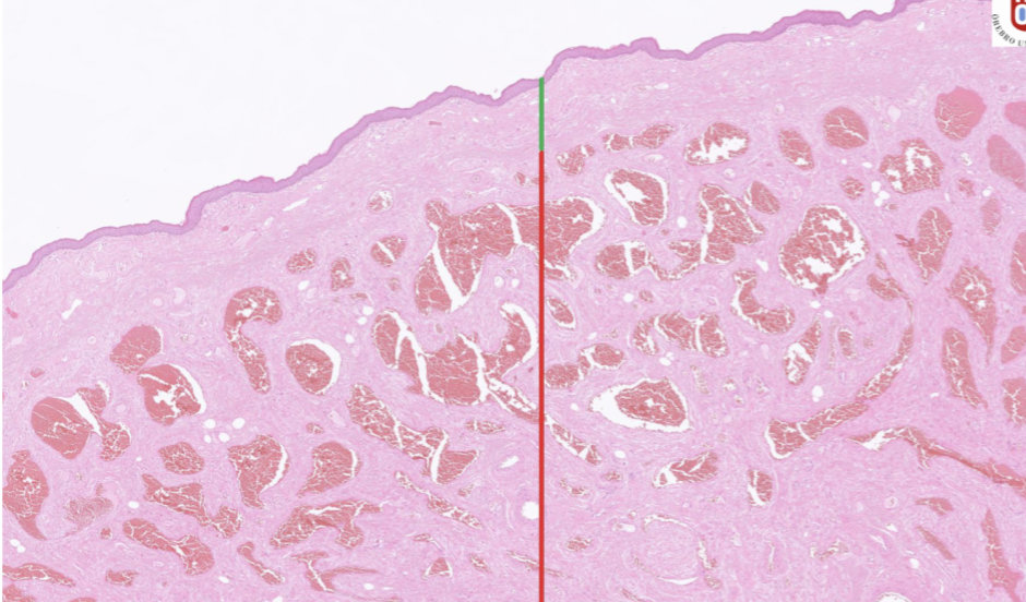 <p>Det består av icke-keratiniserat skivepitel och under lamina propria (kärl + nerver + bindväv) → grönt</p><p>Djupare in finns corpus spongiosum av glattmuskulatur och anastomoserande kärl. </p><p>→ rött</p>