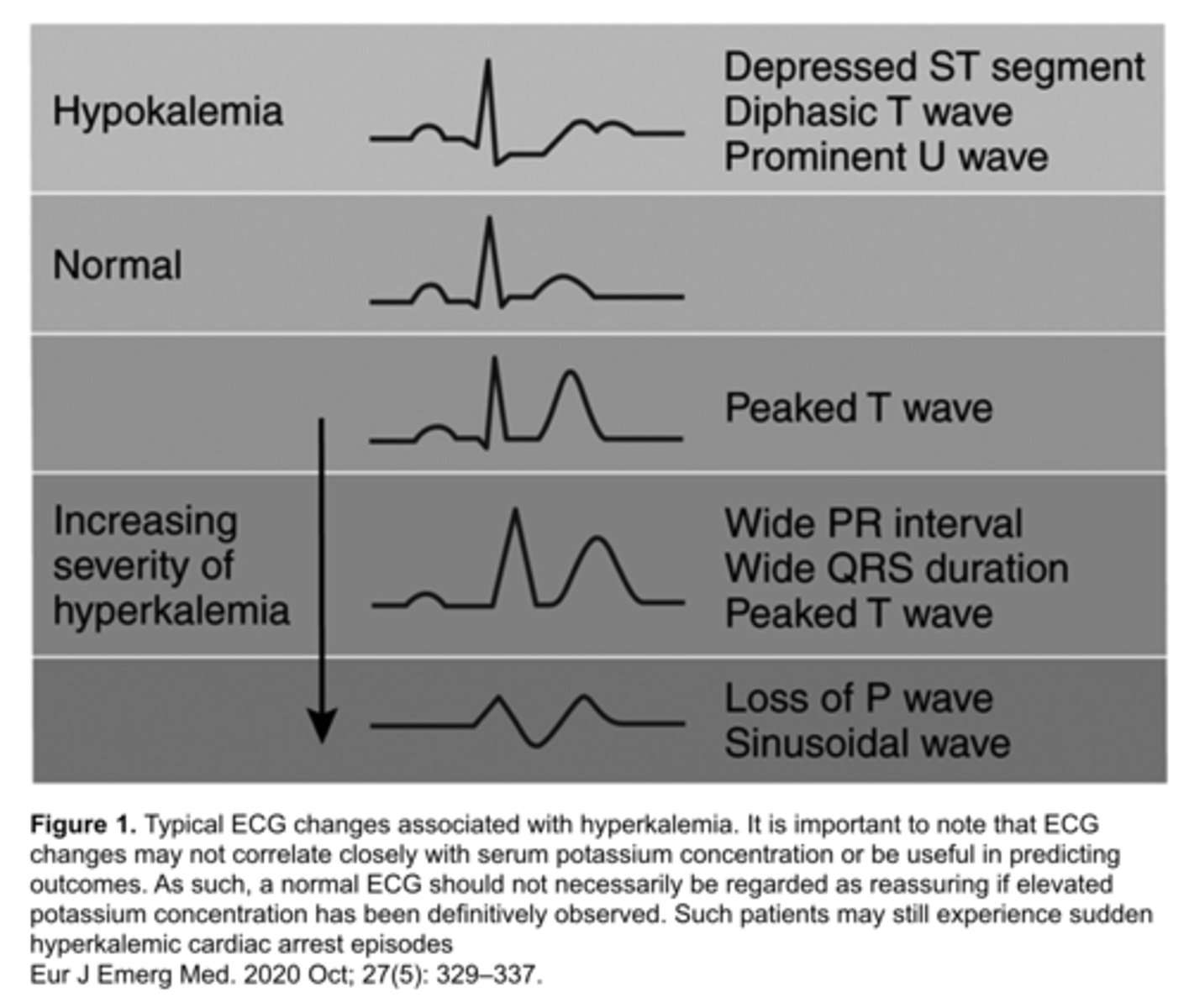 <p>- can lead to ST elevation that mimics STEMI</p><p>- usually in right chest leads (V1-V3) with tall, pointed T waves</p>